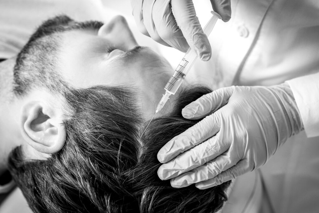 Polynucleotides for Hair Restoration 1 Polynucleotide injections for hair restoration.