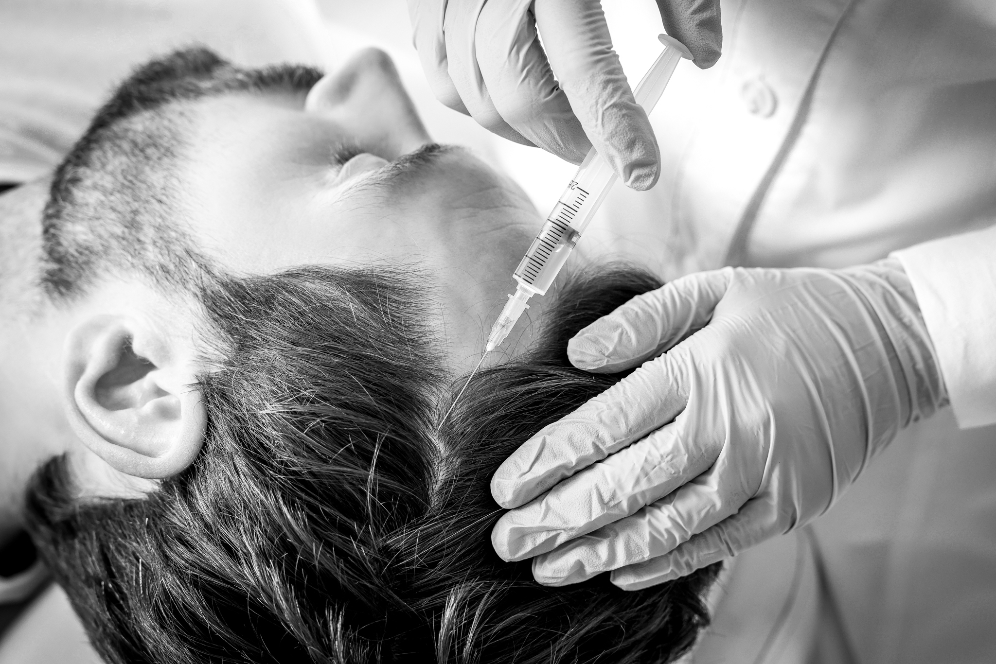 Polynucleotide injections for hair restoration.