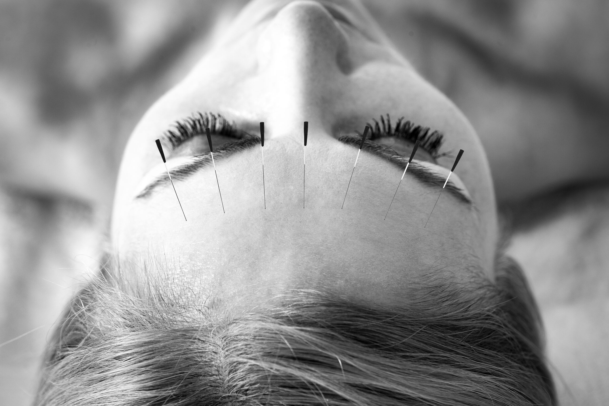 Cosmetic acupuncture
